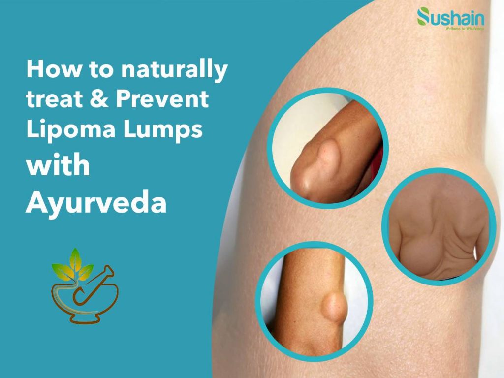 ayurvedic treatment for lipoma