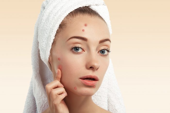 Ayurveda treatment for Acne