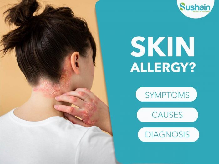 Skin Allergy