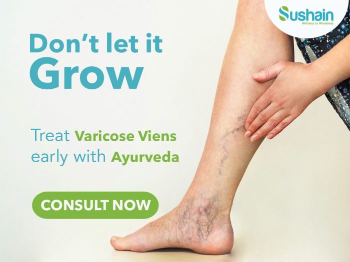 Varicose Veins